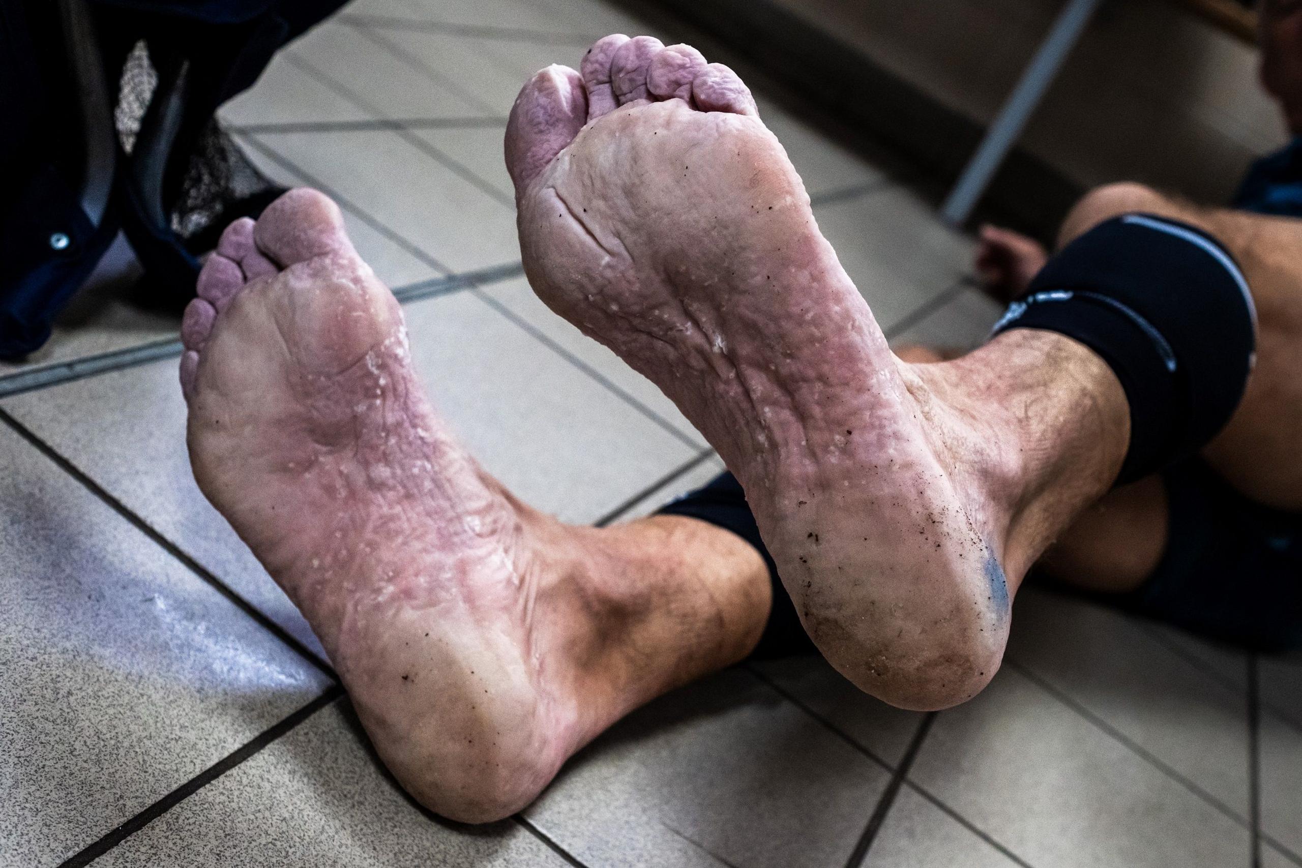 A runner's feet - with suspected trenchfoot  - during the Sri Chinmoy 24hr Track Race in Battersea