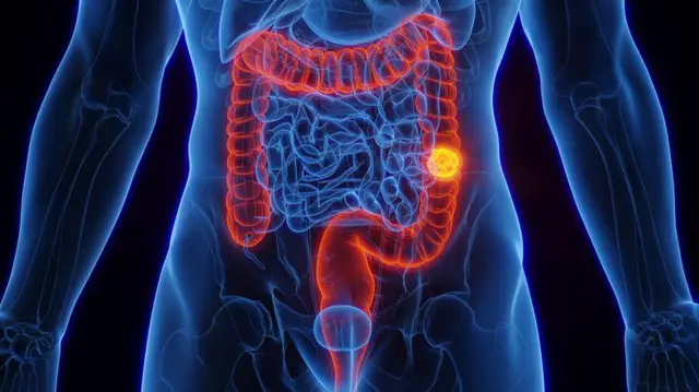 Ilustração de câncer de intestino