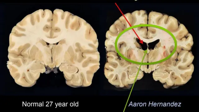 Cérebro de Aaron Hernandez