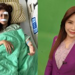 華視美女主播車禍毀容！眼眶、臉骨嚴重碎裂，經7小時手術重建…現況模樣曝光