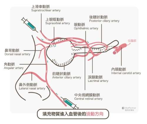 注射物質流動（圖/medpartner）