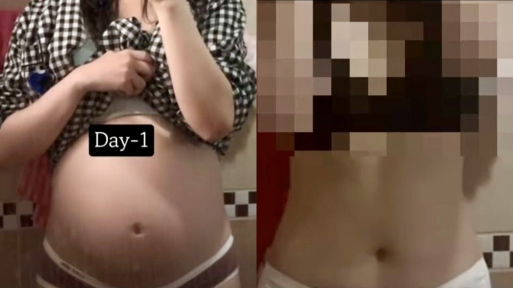A女公開懷孕36周及墮胎後的肚子。 Youtube