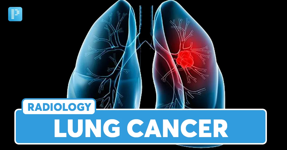 Lung Cancer: Causes, Types, Symptoms and Risk Factors