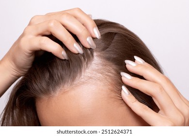 Young woman showing bald spots on forehead and temples with fingers. Baldness. Close-up. Hair care concept and treatment. Hair loss, hair transplant, alopecia