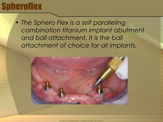 Spheroflex
• The Sphero Flex is a self paralleling
combination titanium implant abutment
and ball attachment. It is the ball
attachment of choice for all implants.
www.indiandentalacademy.com
 