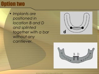 Option two
• Implants are
positioned in
location B and D
and splinted
together with a bar
without any
cantilever.
www.indiandentalacademy.com
 