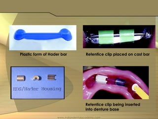 Plastic form of Hader bar Retentice clip placed on cast bar
Retentice clip being inserted
into denture base
www.indiandentalacademy.com
 