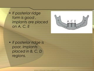 • If posterior ridge
form is good ,
implants are placed
on A, C, E
• if posterior ridge is
poor, implants
placed in B, C, D
regions.
www.indiandentalacademy.com
 