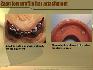 Zaag low profile bar attachment
ZAAG female part placed directly
on the abutment
Male retentive element placed on
the denture base
www.indiandentalacademy.com
 