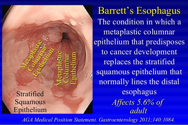 Stages Of Barrett's Esophagus