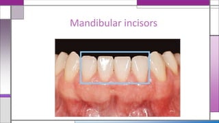 Mandibular incisors
 