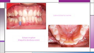 Ectopic eruption
(lingual to deciduous ones)
Lateral distal to canine
 