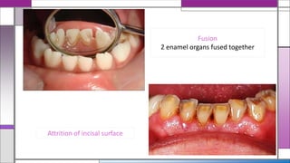 Fusion
2 enamel organs fused together
Attrition of incisal surface
 