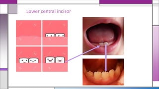 Lower central incisor
 