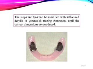 The stops and fins can be modified with self-cured
acrylic or greenstick tracing compound until the
correct dimensions are produced.
6/9/2017
29
 