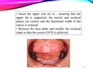 • Insert the upper wax try in - ensuring that the
upper lip is supported, the incisal and occlusal
planes are correct and the functional width of the
sulcus is restored.
• Reinsert the base plate and modify the occlusal
stops so that the correct OVD is achieved.
6/9/2017
31
 