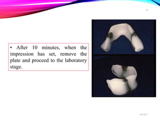 • After 10 minutes, when the
impression has set, remove the
plate and proceed to the laboratory
stage.
6/9/2017
34
 