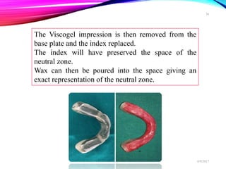 The Viscogel impression is then removed from the
base plate and the index replaced.
The index will have preserved the space of the
neutral zone.
Wax can then be poured into the space giving an
exact representation of the neutral zone.
6/9/2017
36
 