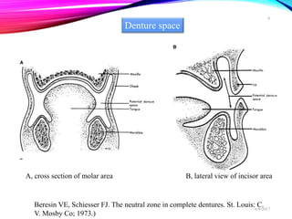 Beresin VE, Schiesser FJ. The neutral zone in complete dentures. St. Louis: C.
V. Mosby Co; 1973.)
A, cross section of molar area B, lateral view of incisor area
Denture space
6/9/2017
6
 