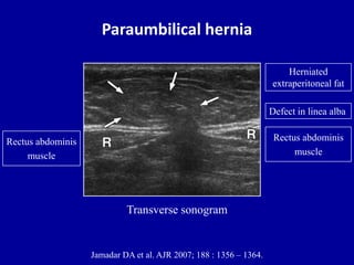 Paraumbilical hernia
Rectus abdominis
muscle
Rectus abdominis
muscle
Transverse sonogram
Defect in linea alba
Jamadar DA et al. AJR 2007; 188 : 1356 – 1364.
Herniated
extraperitoneal fat
 