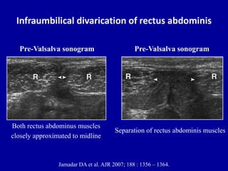 Infraumbilical divarication of rectus abdominis
Pre-Valsalva sonogram
Both rectus abdominus muscles
closely approximated to midline
Jamadar DA et al. AJR 2007; 188 : 1356 – 1364.
Pre-Valsalva sonogram
Separation of rectus abdominis muscles
 