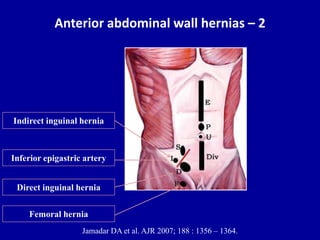 Anterior abdominal wall hernias – 2
Jamadar DA et al. AJR 2007; 188 : 1356 – 1364.
Direct inguinal hernia
Indirect inguinal hernia
Femoral hernia
Inferior epigastric artery
 