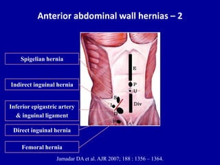 Anterior abdominal wall hernias – 2
Jamadar DA et al. AJR 2007; 188 : 1356 – 1364.
Inferior epigastric artery
& inguinal ligament
Direct inguinal hernia
Indirect inguinal hernia
Femoral hernia
Spigelian hernia
 