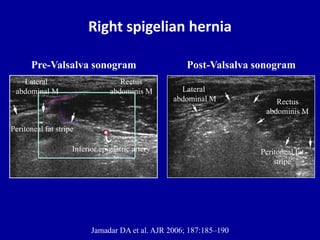 Right spigelian hernia
Jamadar DA et al. AJR 2006; 187:185–190
Rectus
abdominis M
Lateral
abdominal M
Inferior epigastric artery
Peritoneal fat stripe
Post-Valsalva sonogram
Rectus
abdominis M
Lateral
abdominal M
Peritoneal fat
stripe
Pre-Valsalva sonogram
 