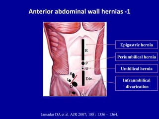 Anterior abdominal wall hernias -1
Jamadar DA et al. AJR 2007; 188 : 1356 – 1364.
Epigastric hernia
Periumbilical hernia
Umbilical hernia
Infraumbilical
divarication
 