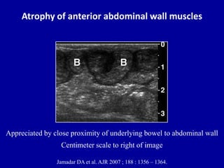 Atrophy of anterior abdominal wall muscles
Jamadar DA et al. AJR 2007 ; 188 : 1356 – 1364.
Appreciated by close proximity of underlying bowel to abdominal wall
Centimeter scale to right of image
 