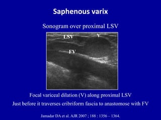 Saphenous varix
Jamadar DA et al. AJR 2007 ; 188 : 1356 – 1364.
Focal variceal dilation (V) along proximal LSV
Just before it traverses cribriform fascia to anastomose with FV
V
FV
LSV
Sonogram over proximal LSV
 