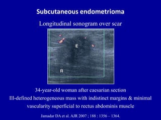 Subcutaneous endometrioma
34-year-old woman after caesarian section
Ill-defined heterogeneous mass with indistinct margins & minimal
vascularity superficial to rectus abdominis muscle
Jamadar DA et al. AJR 2007 ; 188 : 1356 – 1364.
Longitudinal sonogram over scar
 