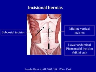 Incisional hernias
Jamadar DA et al. AJR 2007; 188 : 1356 – 1364.
Midline vertical
incision
Lower abdominal
Pfannenstiel incision
(bikini cut)
Subcostal incision
 