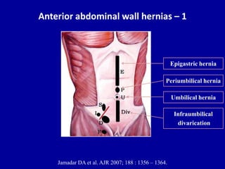 Anterior abdominal wall hernias – 1
Jamadar DA et al. AJR 2007; 188 : 1356 – 1364.
Epigastric hernia
Periumbilical hernia
Umbilical hernia
Infraumbilical
divarication
 