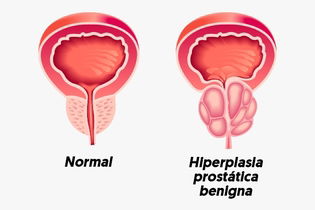 Imagem ilustrativa do artigo Hiperplasia benigna da próstata: o que é, sintomas, causas e tratamento