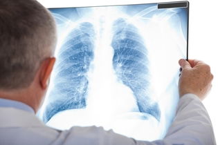 Imagem ilustrativa do artigo Sepse pulmonar: o que é, sintomas, causas e tratamento