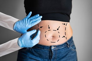 Imagem ilustrativa do artigo Abdominoplastia: o que é, como é feita e complicações