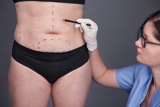 Imagem ilustrativa do artigo Abdominoplastia com lipo: como é feita, resultados e pós-operatório 