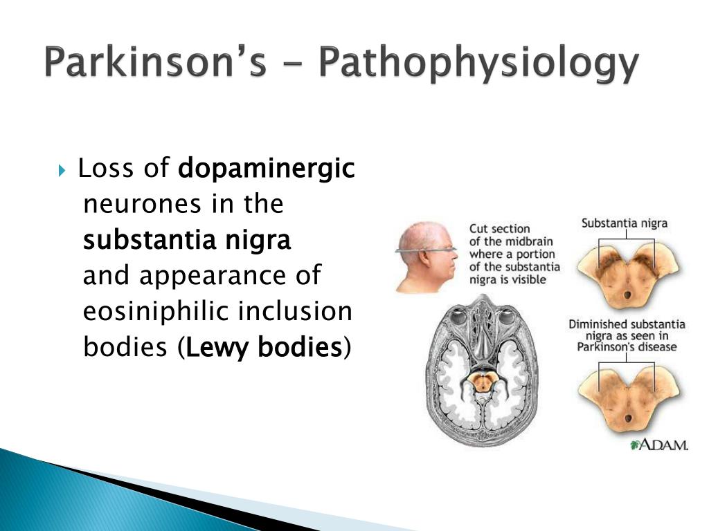 Parkinson's Disease Diagram