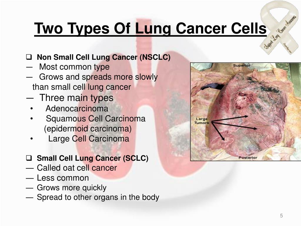 Lung Cancer Types Chart