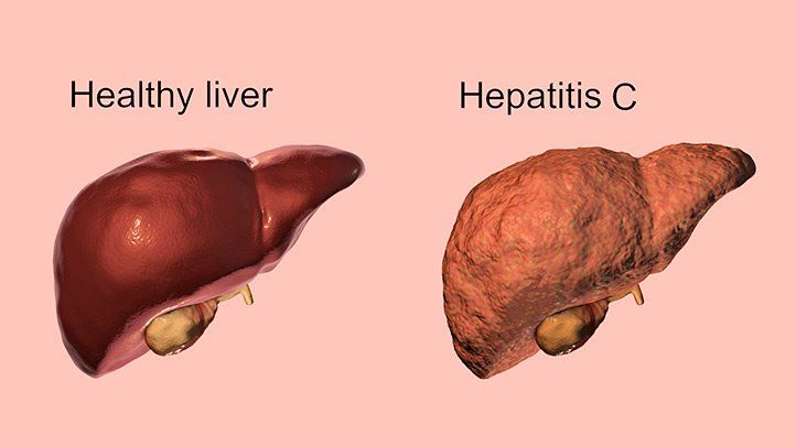 What Is Hepatitis C? Symptoms, Causes, Diagnosis, Treatment, and Prevention