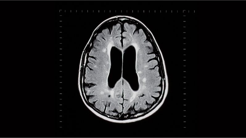 What Multiple Sclerosis Looks Like in Your Brain | Christ Memorial