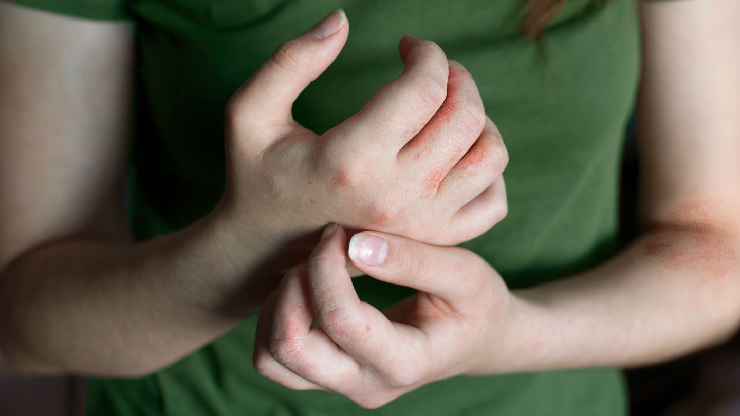 woman's hands distress eczema