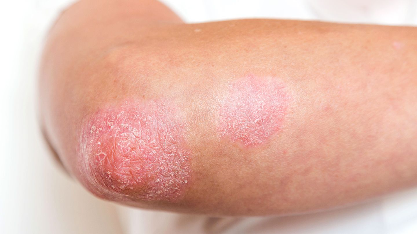 Types of Psoriasis