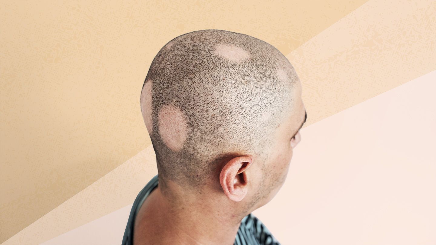 What Are the Different Types of Alopecia Areata?