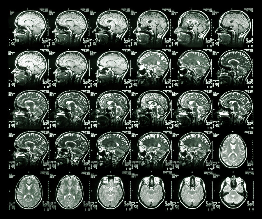 Collection 101+ Pictures Mri Pictures Of Brain Completed