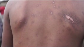 WHO: Mpox infections on the rise