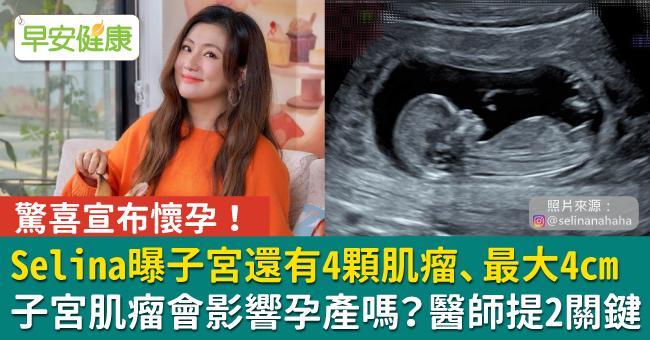 Selina懷孕！苦熬6症狀、4顆子宮肌瘤共存⋯肌瘤不開刀可以嗎？觀察2警訊避癌變