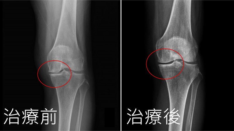 9旬修女膝關節退化難跪禱 自體免疫細胞治療讓她感覺年輕