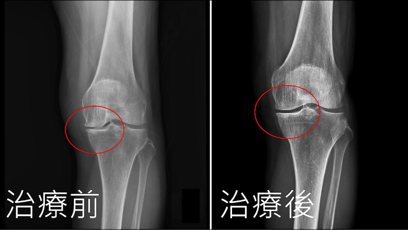 膝關節退化 自體免疫細胞治療改善痠痛